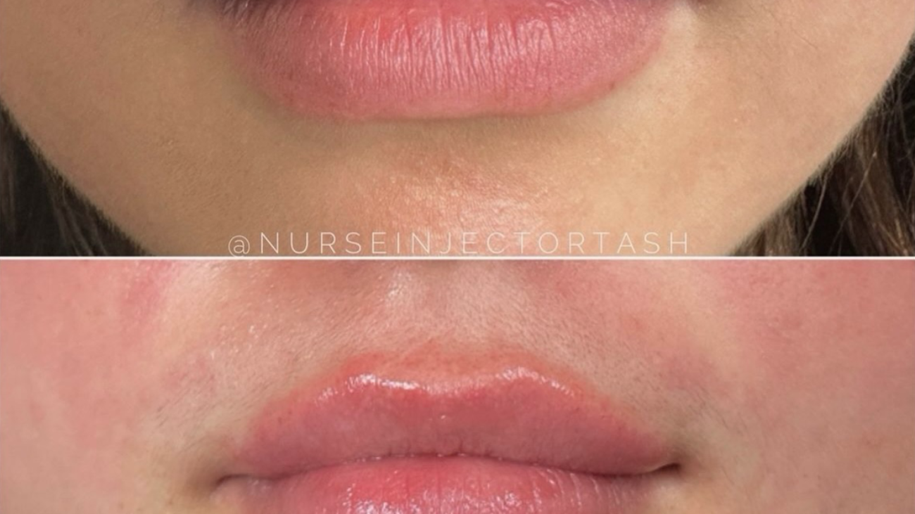 What a Difference a Little Filler Can Make: Transform Your Look with Dr. Danielle West in Burlington, Ontario