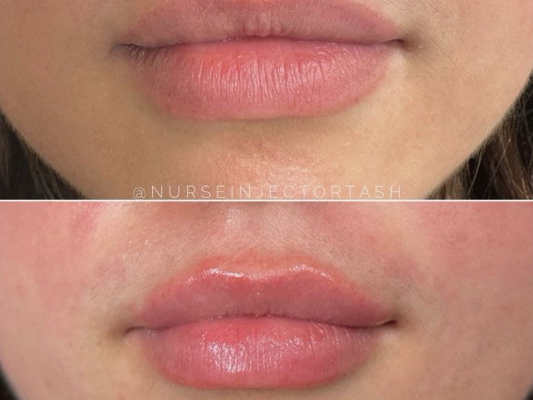 What a Difference a Little Filler Can Make: Transform Your Look with Dr. Danielle West in Burlington, Ontario